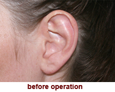 plastic-surgery-prominent-ear 